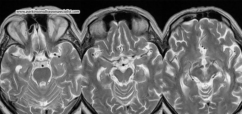 What-Is-Progressive-Supranuclear-Palsy-(PSP)