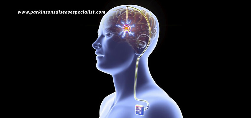 Deep-Brain-Stimulation-The-Before-And-After