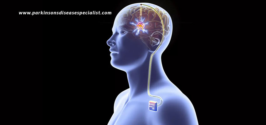 Deep-Brain-Stimulation-The-Procedure-And-Advantages